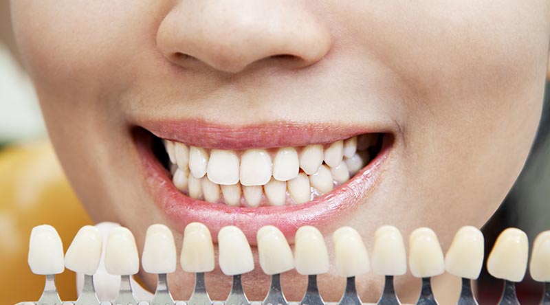 Alternative Methoden zur Zahnaufhellung – gibt es sie wirklich?